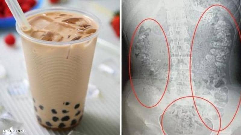 صدمة للأطباء.. 100 “كرة شاي” في أحشاء مراهقة صينية