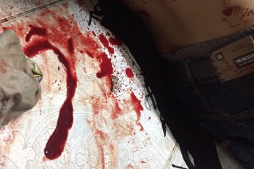 احد المصابين برصاص قوات الأمن البحرينية في الدراز