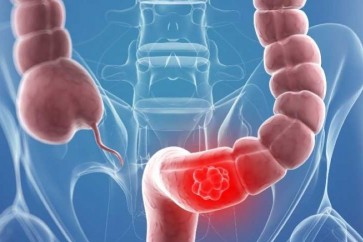 4 طرق للوقاية من سرطان القولون والمستقيم