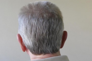 بالإمكان استعادة لون الشعر لدى المرضى الذين يعانون من سرطان الرئة