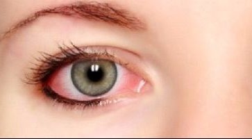 تعرف على أعراض وأسباب التهاب العين عند الأطفال