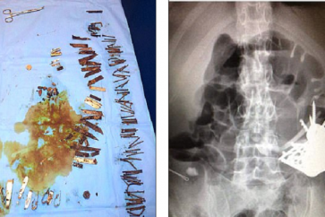 استخراج 100 قطعة معدنية من معدة مريض نفسي!