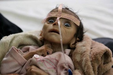 المجاعة تفتك باطفال اليمن جراء العدوان الاميركي السعودي
