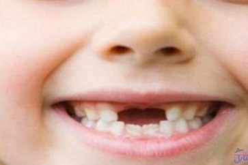 Child Teeth1