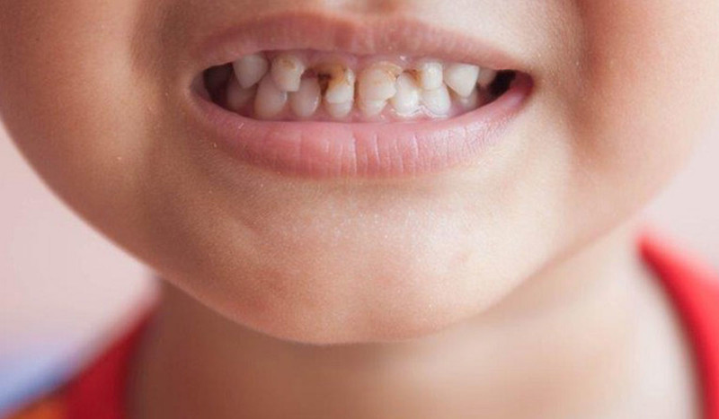  اصفرار اسنان الاطفال عمر سنتين